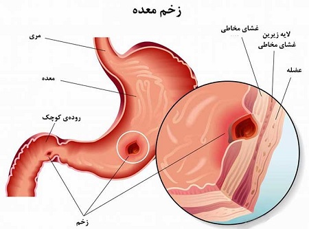 عکس معده 