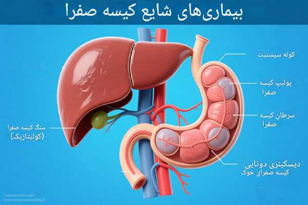 بیماری های مرتبط با کیسه صفری