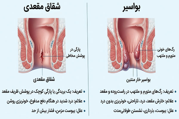تفاوت شقاق با هموروئید