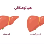 کبد بزرگ شده یا هپاتومگالی