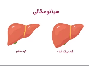 کبد بزرگ شده یا هپاتومگالی