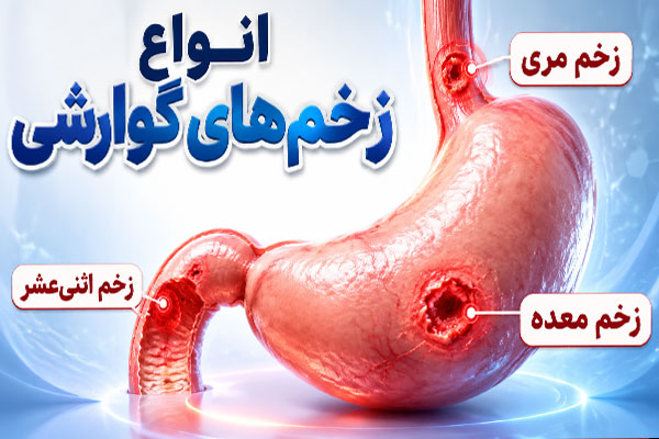 4666 انواع زخم های گوارشی