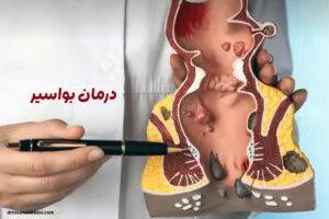 درمان بواسیر