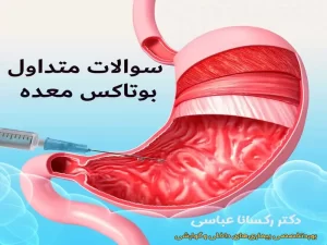 رایج ترین سوالات بوتاکس معده