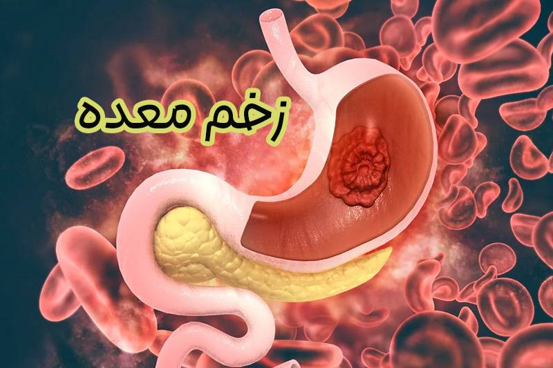 زخم معده