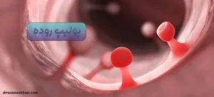 پولیپ روده
