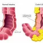 بیماری کرون