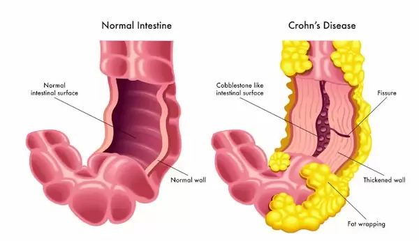 بیماری کرون