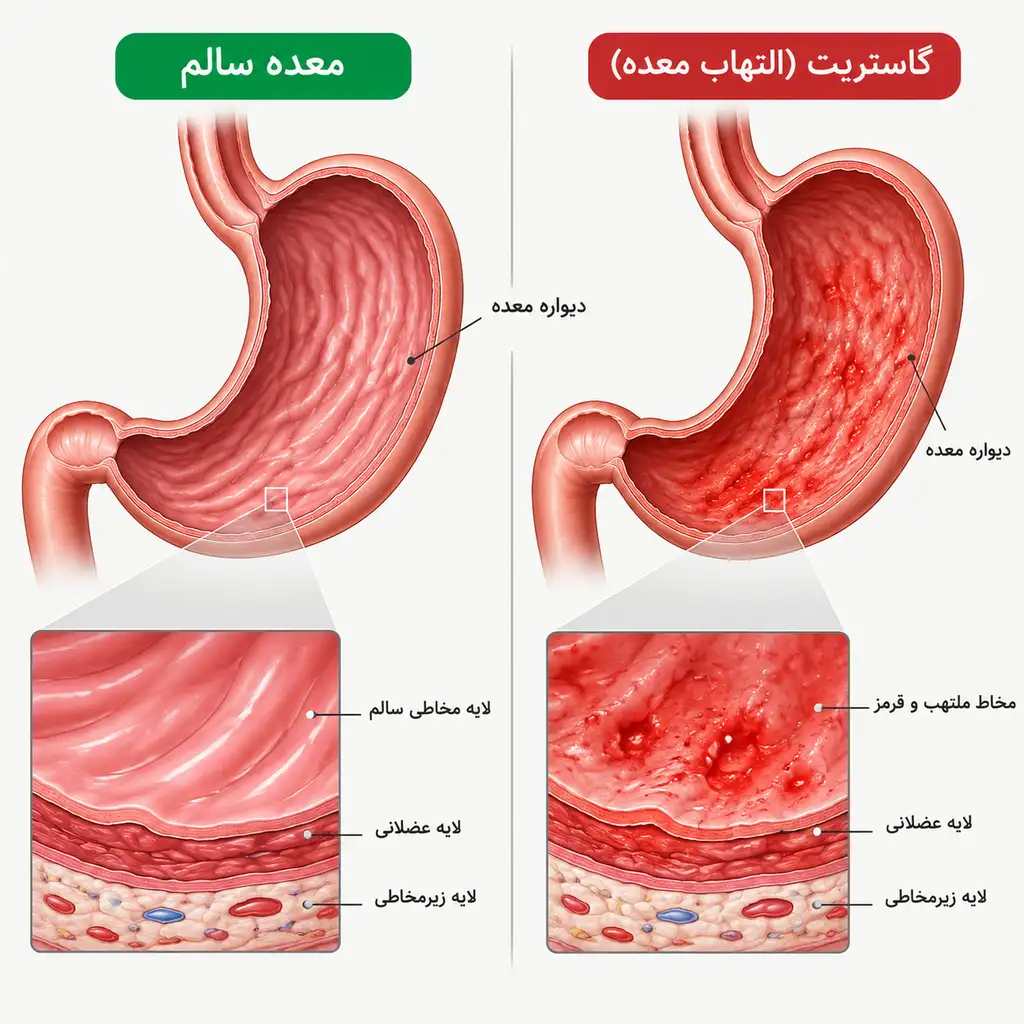 گاستریت معده 