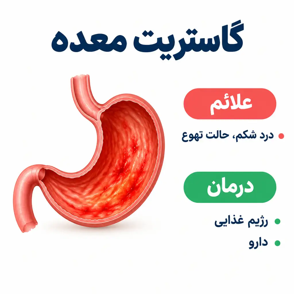 گاستریت معده 