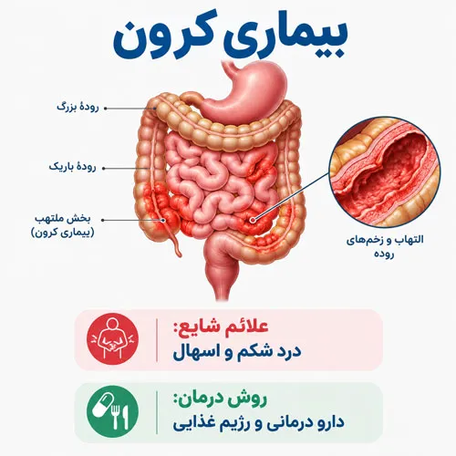 بیماری کرون