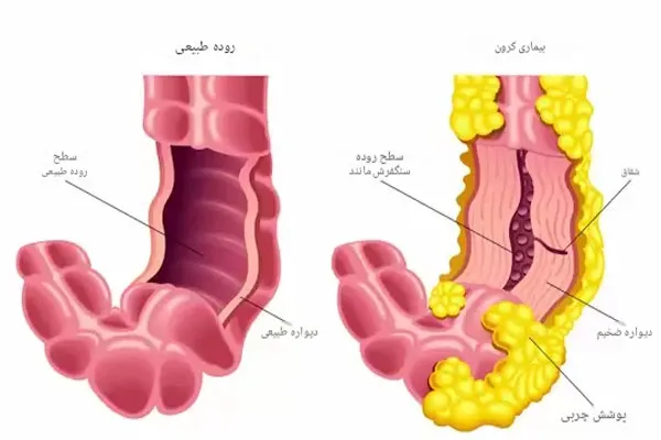 بیماری کرون