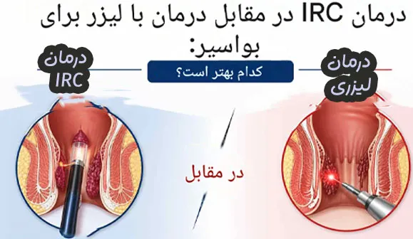 درمان هموروئید با IRC