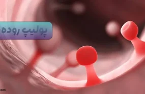 پولیپ روده
