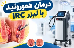 درمان هموروئید با لیزر IRC