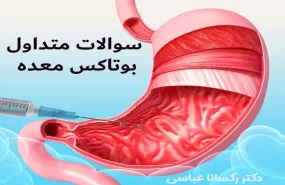 رایج ترین سوالات بوتاکس معده