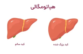 کبد بزرگ شده یا هپاتومگالی