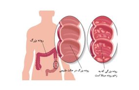 کولیت روده